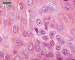 Merkel Cell Carcinoma Histology