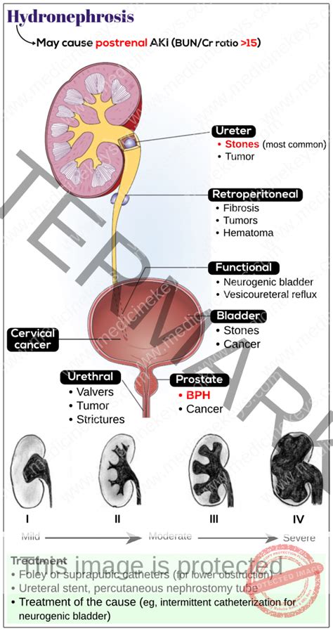 Hydronephrosis - Medicine Keys for MRCPs