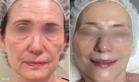 Face Photo Gallery - Anti-Aging | Face Beauty Science