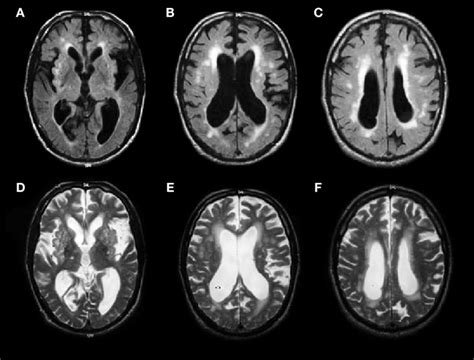 Parkinson S Disease Brain Region Brain Mri Scans Of A Patient With | My XXX Hot Girl