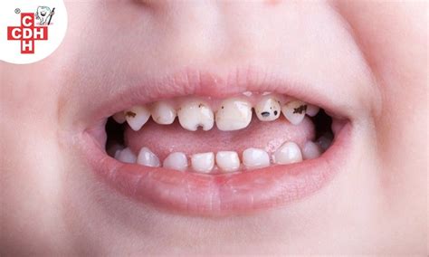 Causes and Prevention of early childhood caries - #1 CDH