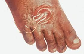 Dracunculiasis | France| PDF | PPT| Case Reports | Symptoms | Treatment