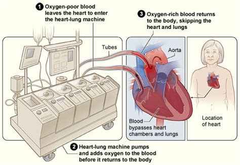 Coronary Artery Bypass Grafting - What to Expect During Surgery | NHLBI ...