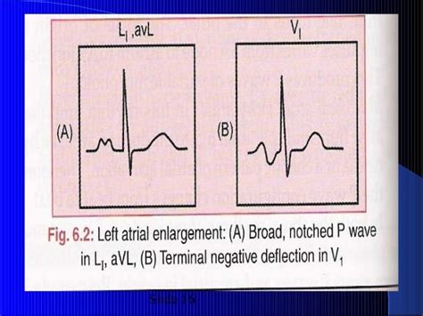 ECG