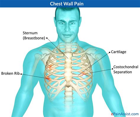 Know What Can Cause Chest Wall Pain and Its Treatment