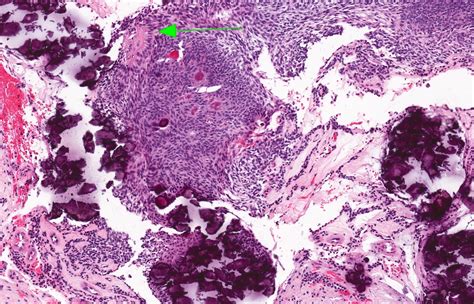 Pathology Outlines - Adenomatoid odontogenic tumor