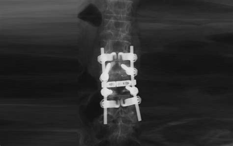 What is Lumbar Spinal Fusion? | Premia Spine