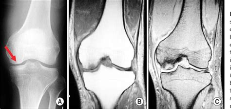 treatment of subchondral fracture knee - shanelle-damario