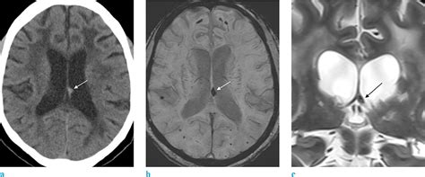 The Fornix: Functional Anatomy, Normal Neuroimaging, and Various ...