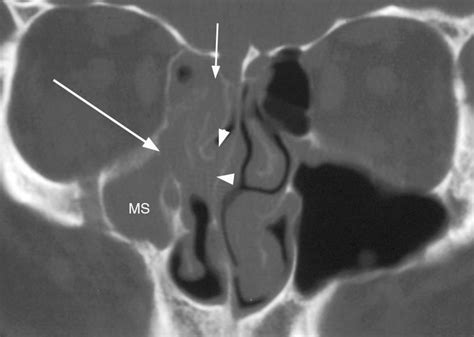 Maxillary Sinus: Abnormal