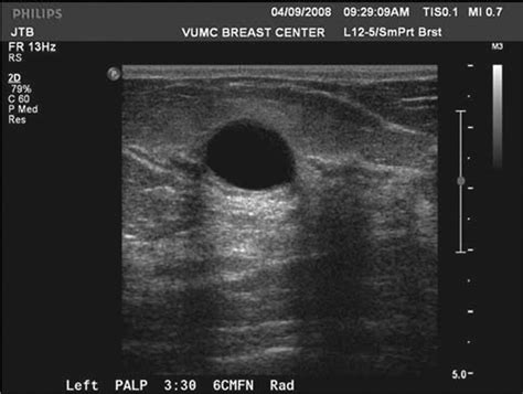 Breast Cyst Ultrasound