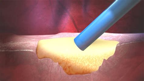 SURGIFLO Hemostatic Matrix Mechanism of Action | Johnson & Johnson ...