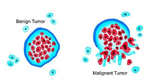 What is cancer? - RareCan