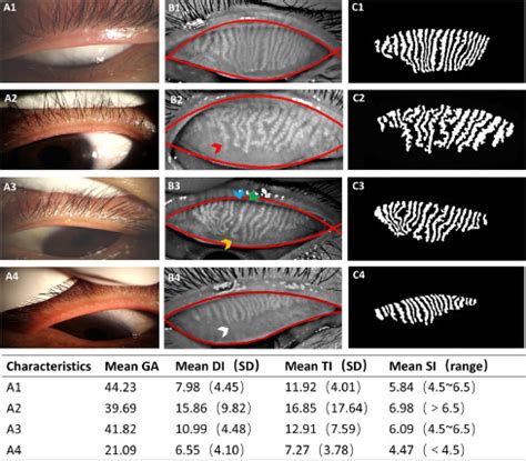 Quantitative analysis of morphological and functional features in Meibography for Meibomian ...