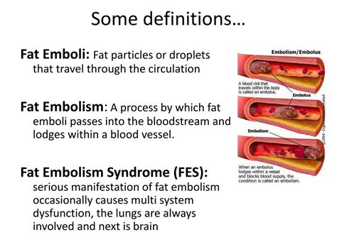 PPT - Fat Embolism Syndrome (FES) PowerPoint Presentation, free ...