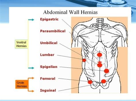 Ventral hernia by Dr Teo