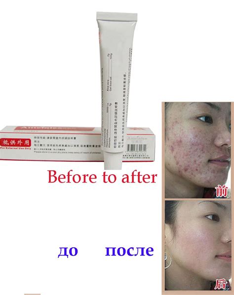 15g Women Freckle Dark Spots Removal Cream Skin care Acne Spot And Sun ...