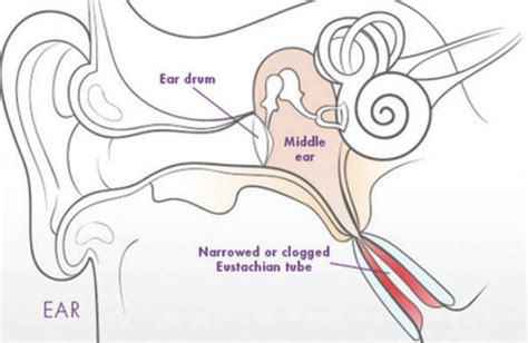 Eustachian Tube Dysfunction Chicago | Hearing Loss Chicago