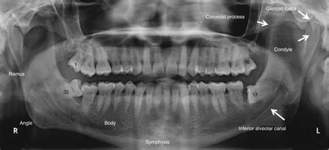 Maxilla and Mandible | Radiology Key