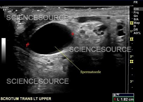 Spermatocele, Ultrasound | Stock Image - Science Source Images