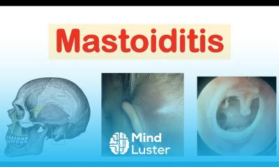 Learn Mastoiditis Acute Otitis Media Causes Pathophysiology Symptoms ...