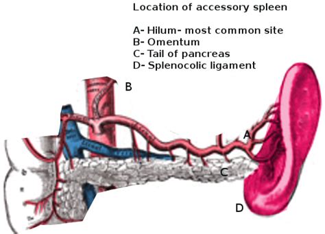 Anatomy, Abdomen and Pelvis: Accessory Spleen - StatPearls - NCBI Bookshelf