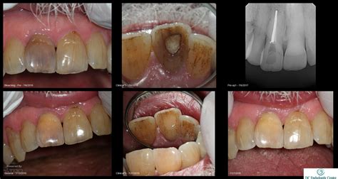 Non-vital Bleaching – TDO University