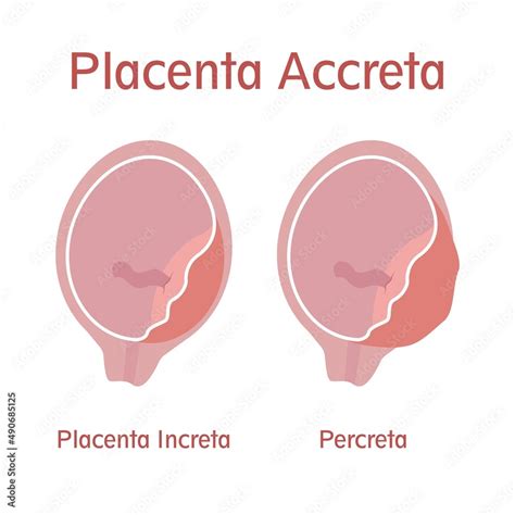 Types of placenta accreta: Placenta Increta and Percreta Stock Vector ...