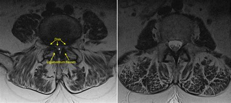 Lumbar spinal stenosis - Radiology at St. Vincent's University Hospital