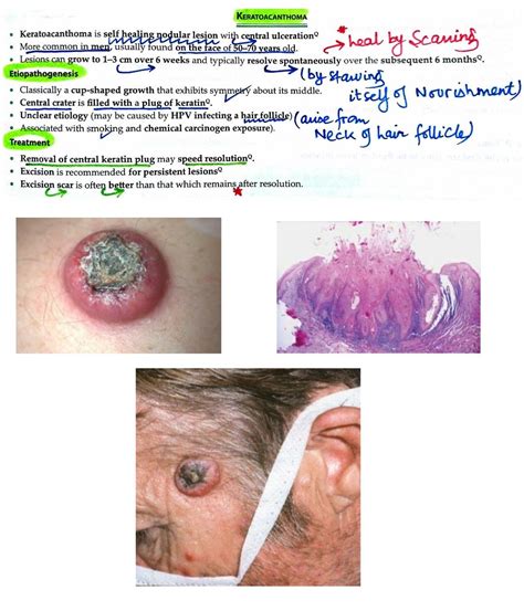 Keratoacanthoma ... | Dermatology, Skin conditions, Derm