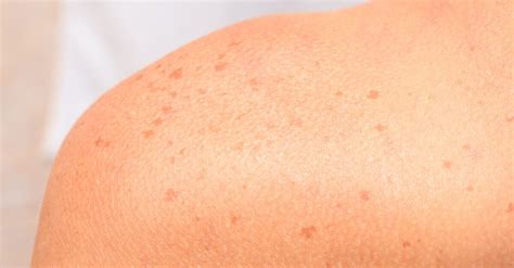 What Causes Sunspots and How Are They Treated?