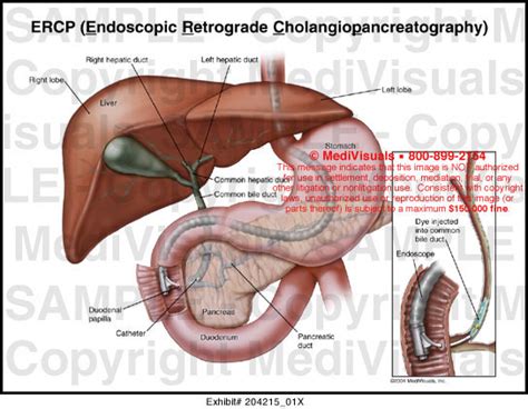 ERCP (Endoscopic Retrograde Cholangiopancreatography) Medical Exhibit