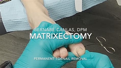 Matrixectomy (Permanent Toenail Removal) - YouTube