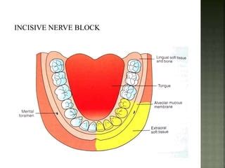 Lingual Nerve Block