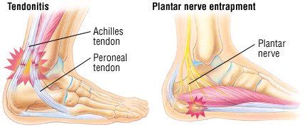 Heel Pain Guide: Causes, Symptoms and Treatment Options