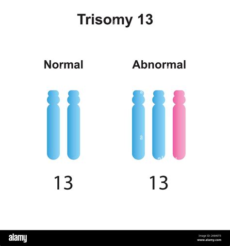 Scientific Designing of Patau Syndrome (Trisomy 13). Colorful Symbols ...