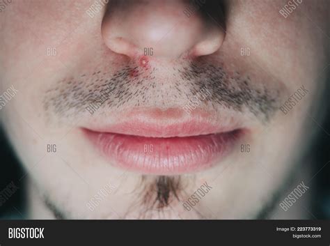 Pimple Under Nose Image & Photo (Free Trial) | Bigstock