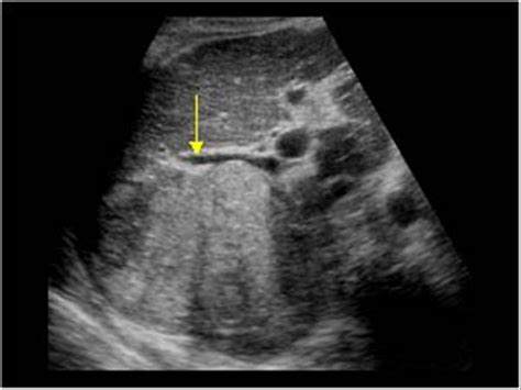 Liver Cancer Ultrasound