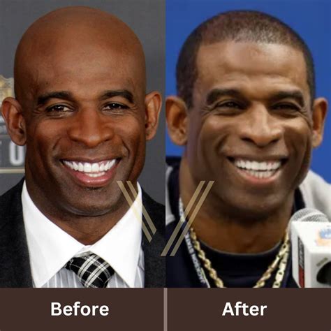 Deion Sanders' Hair Transplant: Before and After Transformation