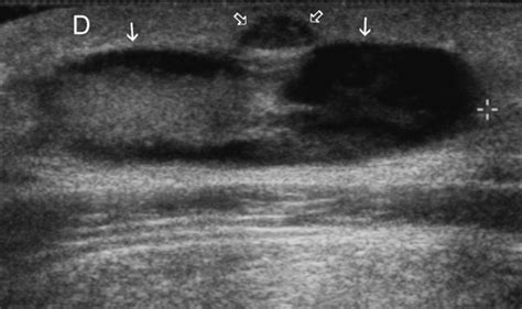 Subcutaneous Dermoid Cyst Ultrasound