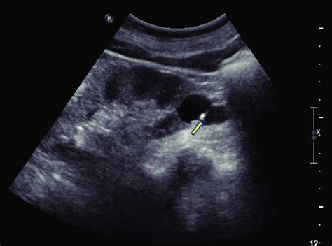 Bosniak class II. Ultrasonography demonstrates a cyst with thin ...