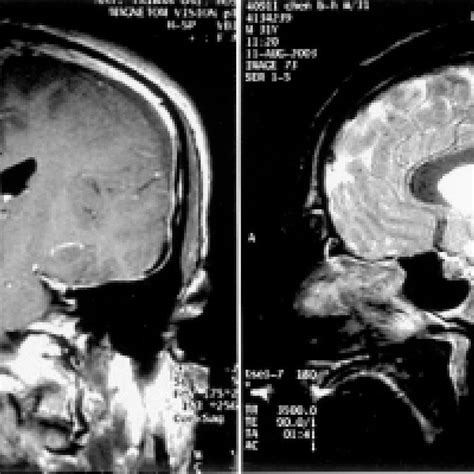 Posterior images of 99m Tc-DTPA radionuclide cisternogram obtained at... | Download Scientific ...