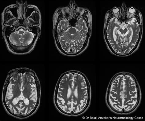 Dr Balaji Anvekar FRCR: Posterior cortical atrophy MRI