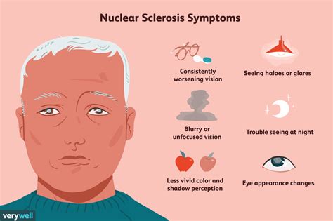 Nuclear Sclerosis: Symptoms, Causes, and Treatment