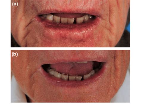 80-year-old lady with actinic cheilitis of the lower lip before (a) and ...