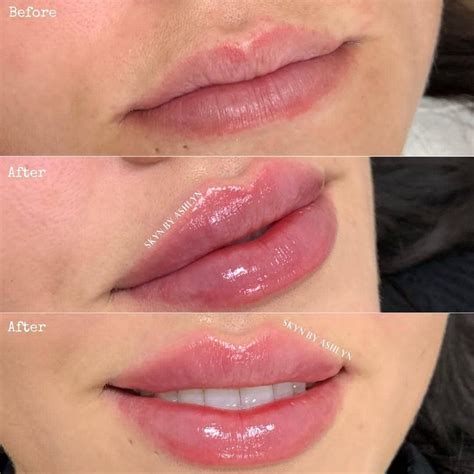 Best of Cosmetic Dermatology on Instagram: “Before/after lip filler ...