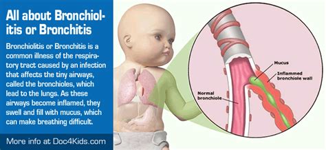 All about Bronchiolitis or Bronchitis - Pediatric Affiliates of Hampton ...