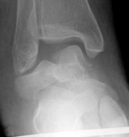 Talus Fracture (other than neck) - Trauma - Orthobullets