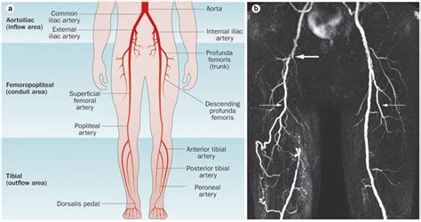 The Femoral. And the External Iliac. – Fleming's Bond