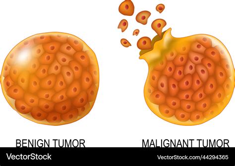 Cancer cells in benign neoplasm and malignant Vector Image